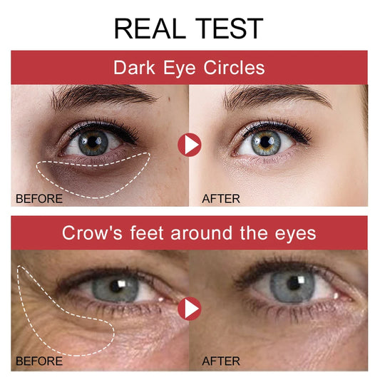 Eye Cream Dark Circles Remover